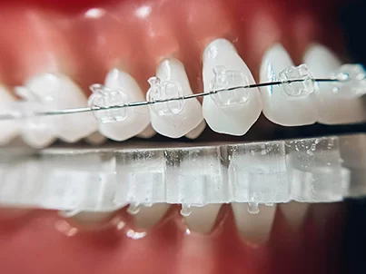 Invisalign 101: Learn the Ins and Outs of Our #1 Orthodontic Appliance