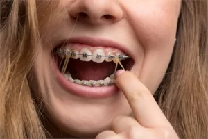 Elastics for Braces – Everything You Need to Know